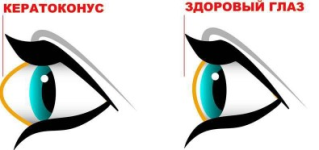 ljudmila-lazareva-ubiraem-keratokonus-vozvraschaem-normalnuju-formu-glaz-2023.png